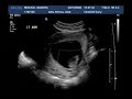 12 week baby scan (full version)