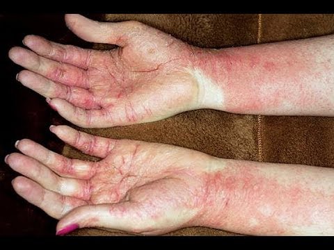 how to relieve eczema on hands