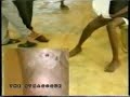 Leg Cancer Healed