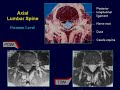 Lumbar Stenosis by Pablo Pazmino MD