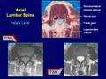 Lumbar Stenosis by Pablo Pazmino MD