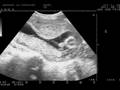 videos de Brittany's Ultrasound at 15 weeks