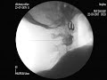 cortisone injection