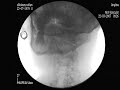 cortisone injection