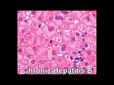 how to recover hepatitis b