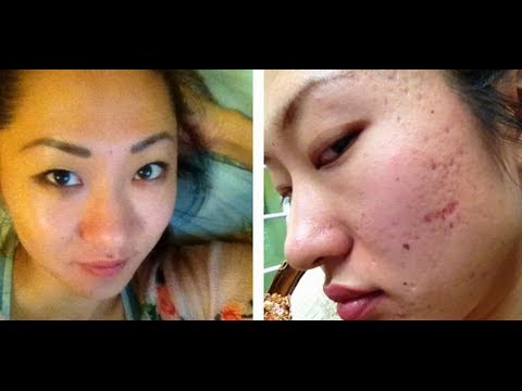 how to remove pimple scars