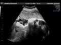 videos de Ultrasound Video