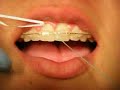 Bracesquestions.com – Flossing With Braces, How to Floss Teeth