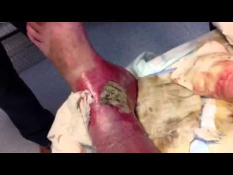 how to treat leg ulcers