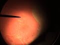 Anat. Patológica - Hipertrofia Anat. Patológica - Hipertrofia