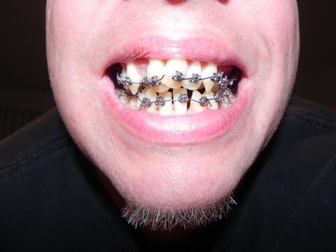 how to whiten your teeth after braces