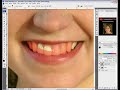 Blanqueo de dientes