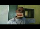 herpes