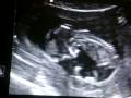13 week ultrasound of baby Beanz.