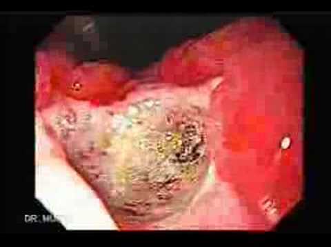 Endoscopy of two Giant Gastric Ulcers