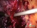 Laparoscopic Radical Prostatectomy Laparoscopic Radical Prostatectomy