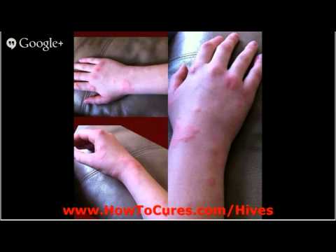 how to cure aquagenic urticaria