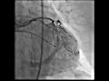 ローターブレーター Rotor Bratro 5 Ischemic Heart Disease