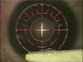 Intralase Lasik Pt. 2