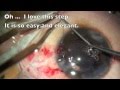 Dislocated Lens in a young boy.