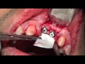 Cirugía implantes