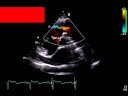 pulmonic insufficiency