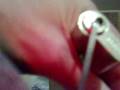 videos de Lock Picking Citadel 5 pin euro cylinder SPP'd