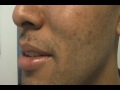 The Acne Practice  (Mild Persistent Acne)