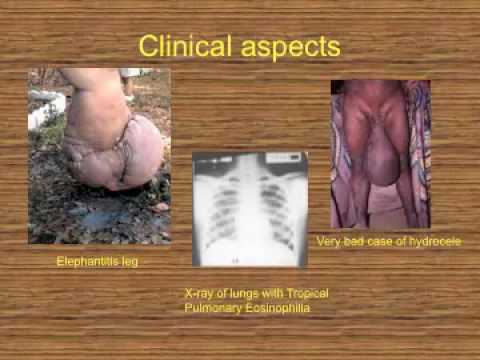 how to treat wuchereria bancrofti