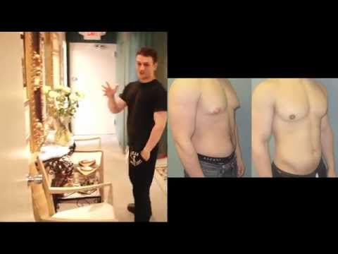 how to perform gynecomastia surgery