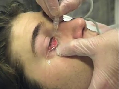 how to perform eye irrigation