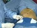 Liposuction Surgery Video