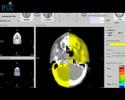 Advances In Cancer Management TomoTherapy (Part2) Advances In Cancer Management TomoTherapy (Part2)