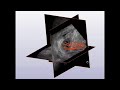 Biopsies Prostate 3D Biopsy of the Prostate