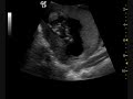 Baby Pulsifer
