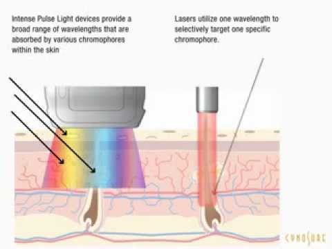 how to treat ipl laser burns
