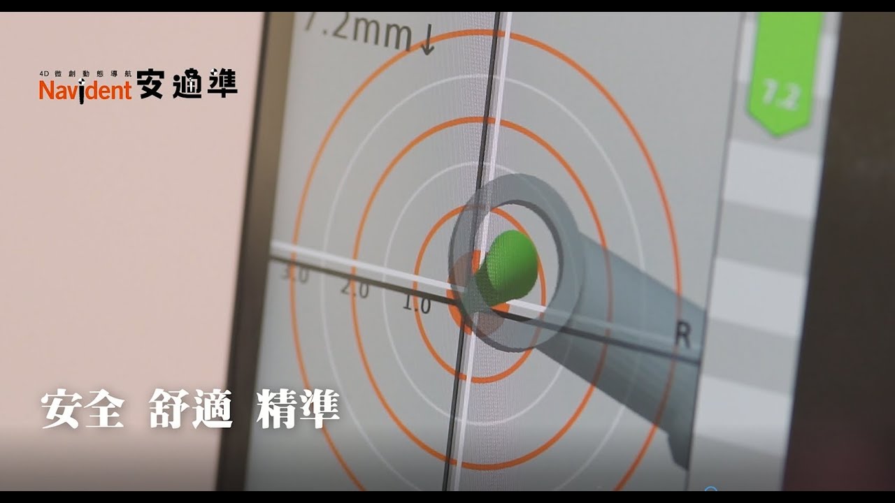 《4D導航植牙》台南安平植牙推薦-新科技導航微創植牙 | 適康牙醫