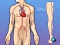 Medical Malpractice Coronary Artery Bypass Graft (CABG) Surgery 1