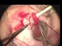 Leukoplakic Lesion Leukoplakic Lesion