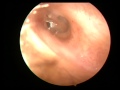 EAR WAX THIN SHEET NEAR EAR DRUM CAUSING NOISE