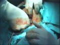 sezeryan,cesarean, doğum anı,césarienne ,kaiserschnitt