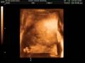 3d Ultrasound - Baby Hartman