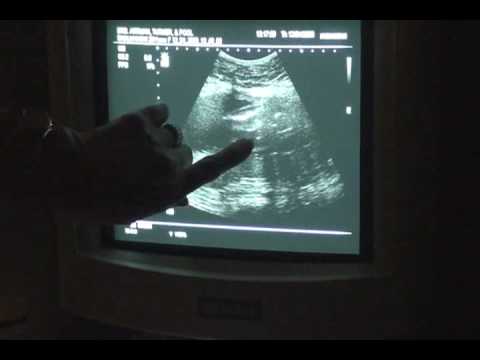 how to know baby gender without ultrasound