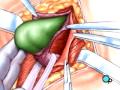 PreOp® Patient Education:  Hernia Repair Inguinal Surgery 1