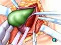 PreOp® Patient Education: Hernia Repair Inguinal Surgery 1