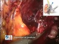 Robotic-Assisted Laparoscopic Radical Prostatectomy (RALRP) Robotic-Assisted Laparoscopic Radical Prostatectomy (RALRP)