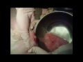 Cat Bite Abcess Drainage *Graphic*