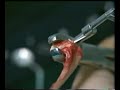 ACL Reconstruction all-inside Part1