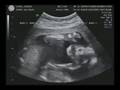 Ej @ 18 wks