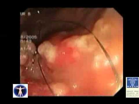 how to perform colonoscopy